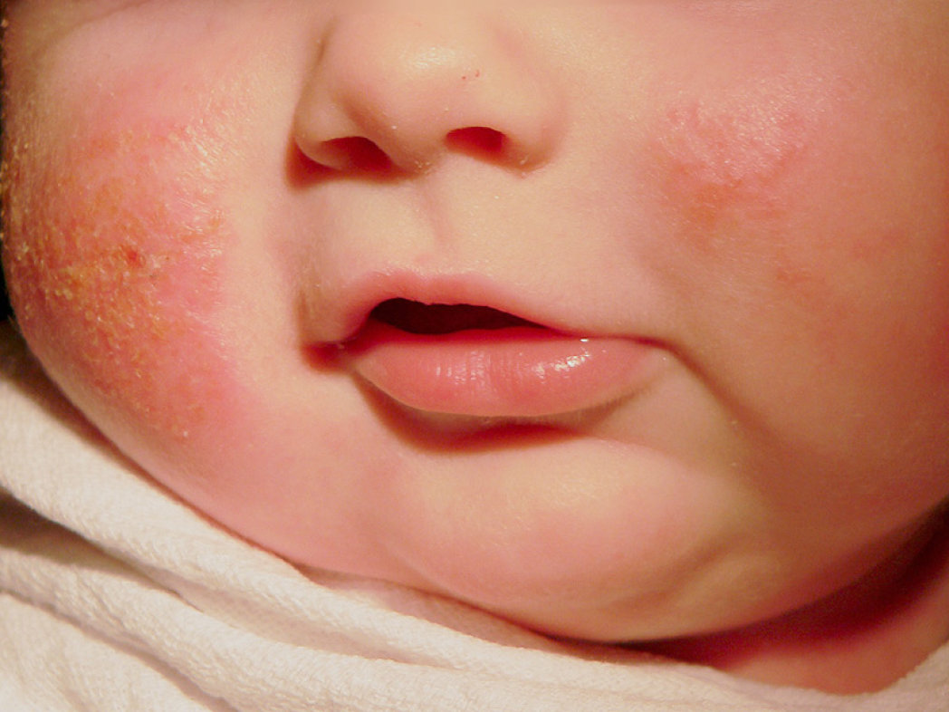 Atopijski dermatitis kod beba i djece