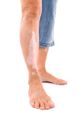 kako-tretirati-vitiligo