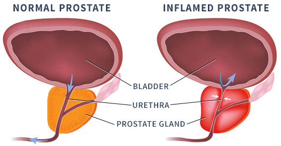 a prosztatitis ureteritis szövődménye prostata con adenoma bilobato