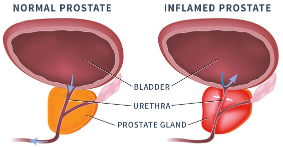 a prostatitis hatását a szívre