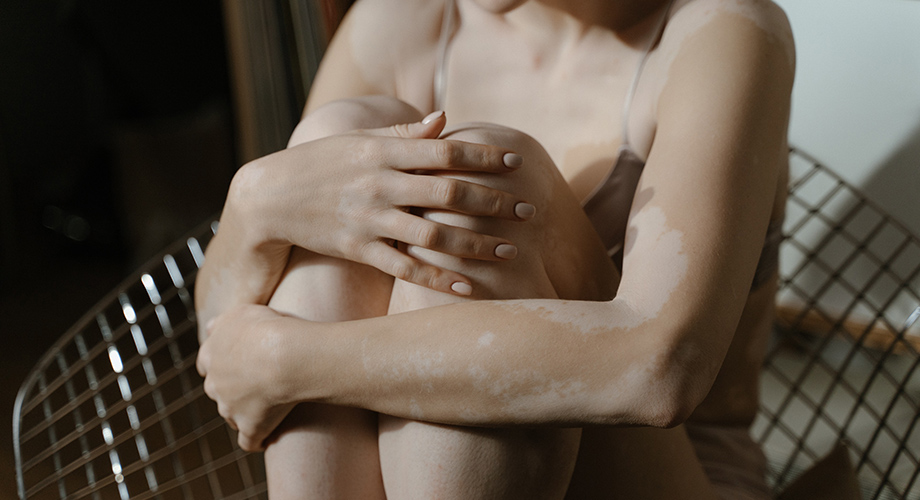 Vitiligo karakterizira gubitak pigmenta