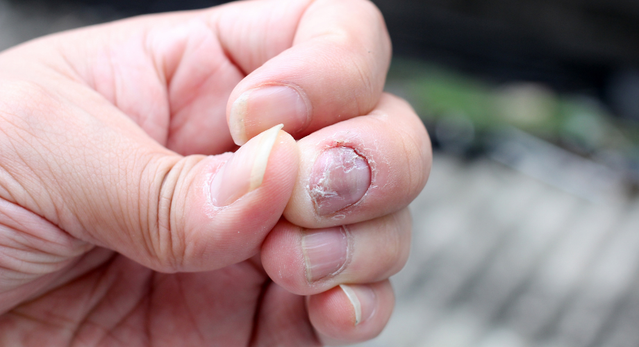 Postoji nekoliko tretmana koji se mogu primijeniti u slučaju psorijaze noktiju.