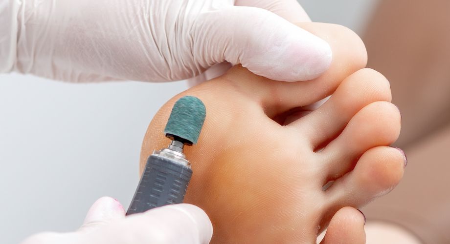 Neke od najčešćih situacija u kojima je potreban piling stopala su atletsko stopalo, suhu kožu, ekcem, psorijaza i hiperhidroza.