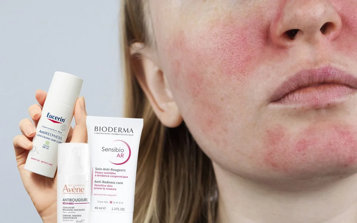 Rozacea kreme i tretmani koji pomažu